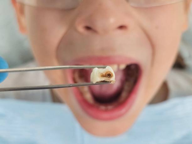 Best Emergency Gum Treatment in Weaverville, NC